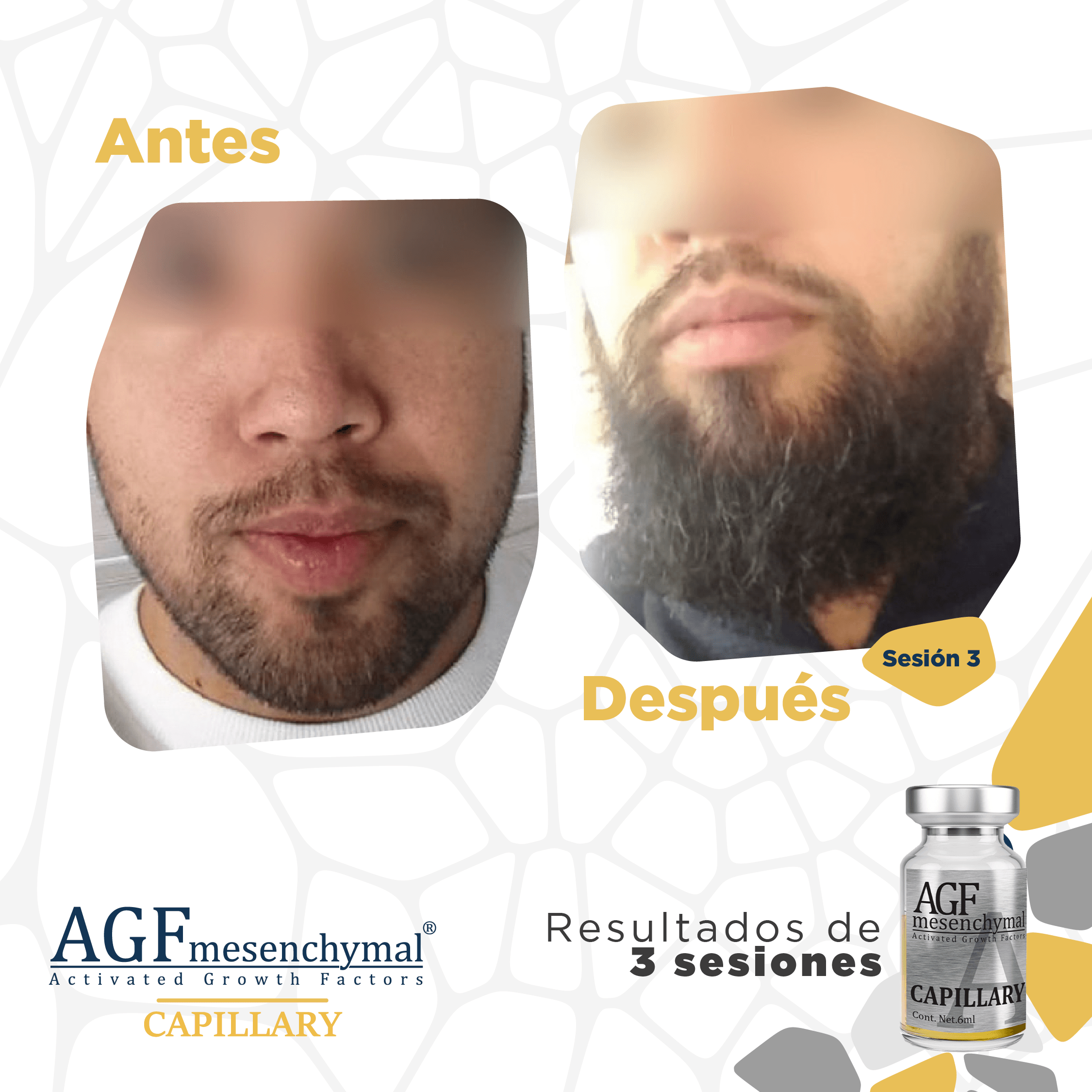 Manufacturer's before-and-after example after 3 sessions of AGF Mesenchymal Capillary