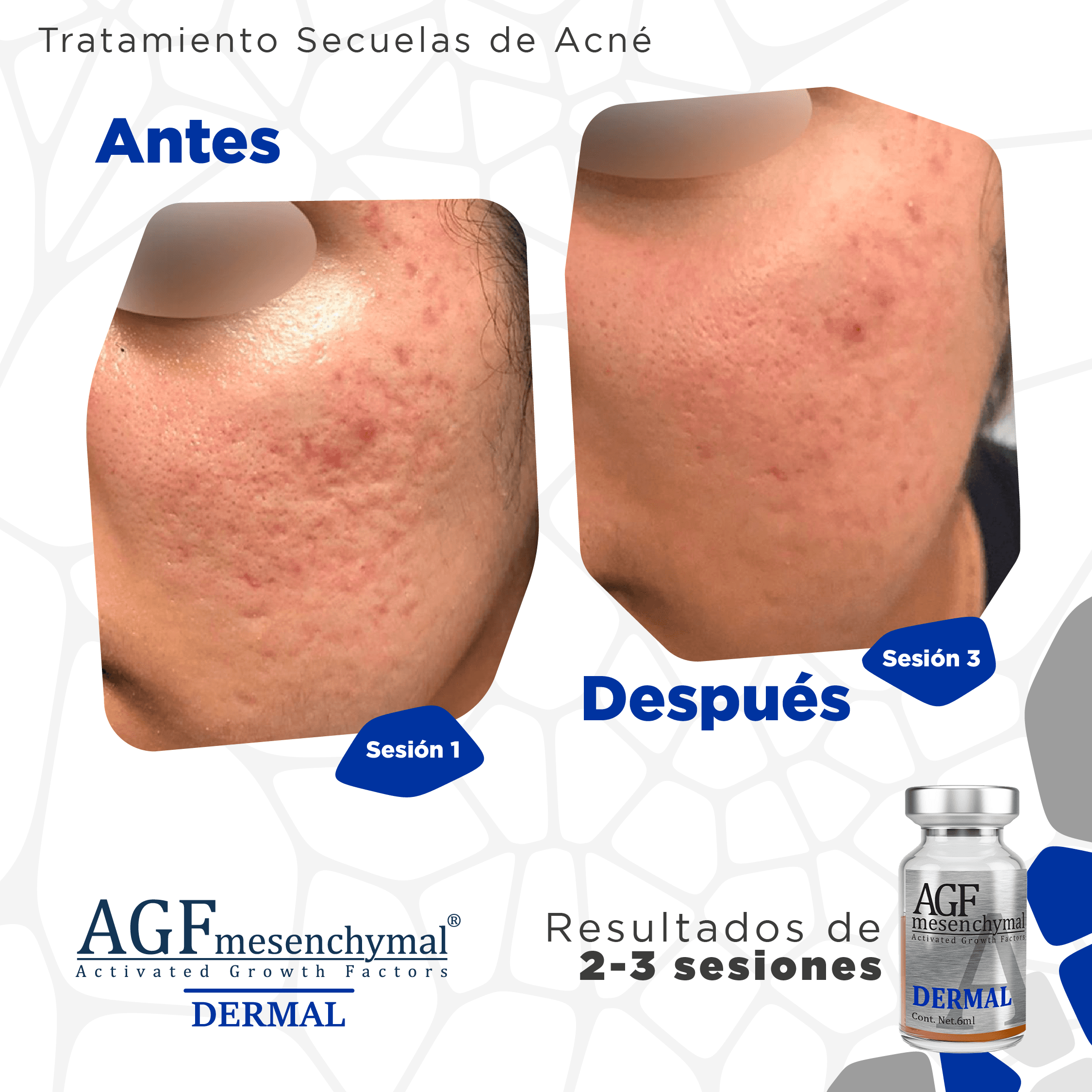 Manufacturer's before-and-after example after 5 sessions of AGF Mesenchymal Dermal